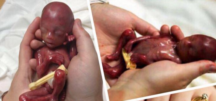abortus11